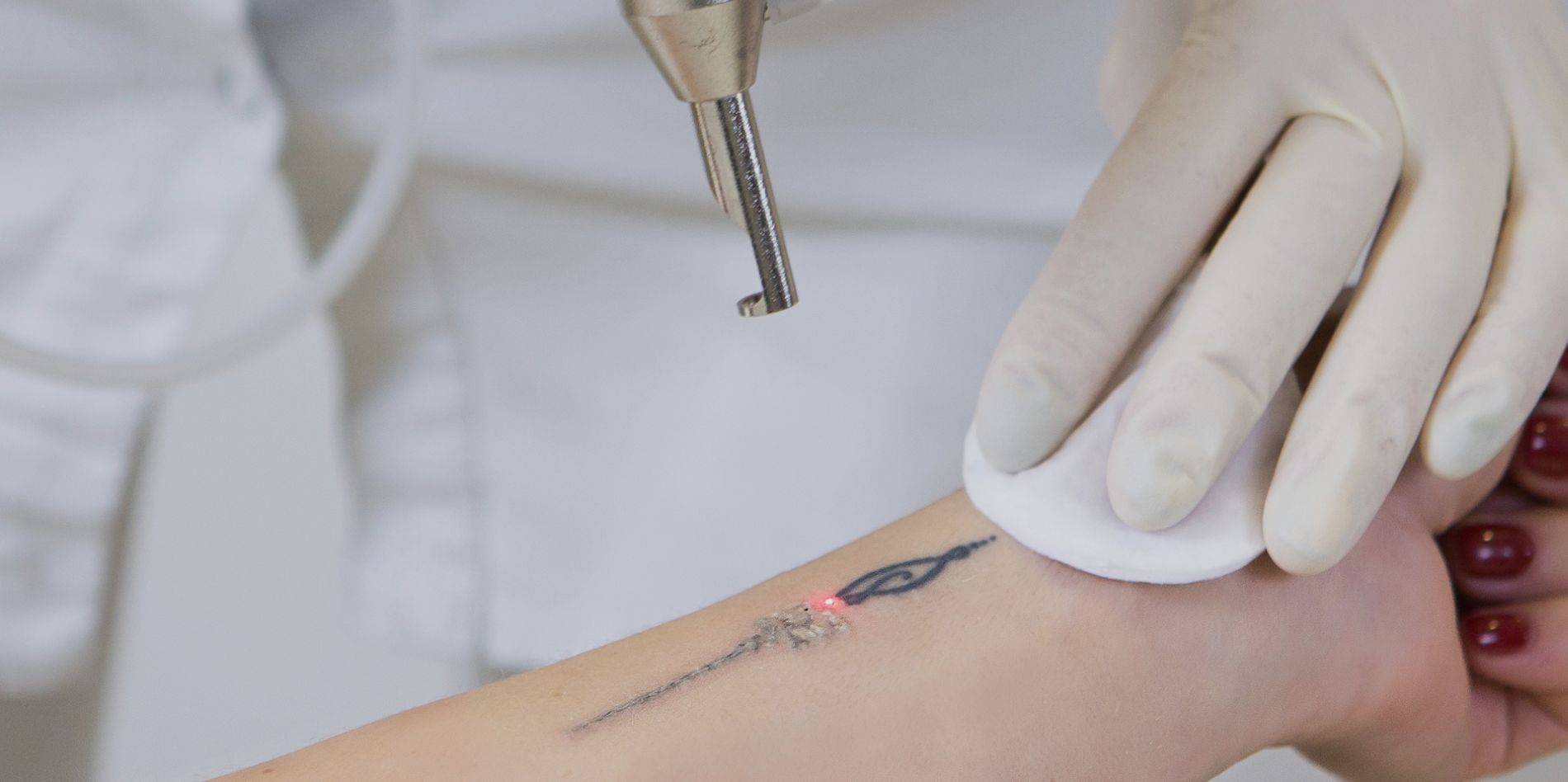 Vish Clinic Tattoo Slide